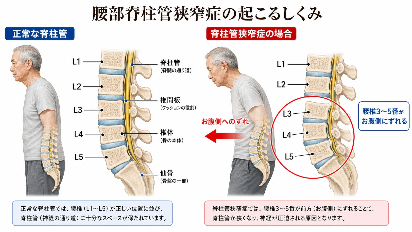 脊柱管狭窄症の図